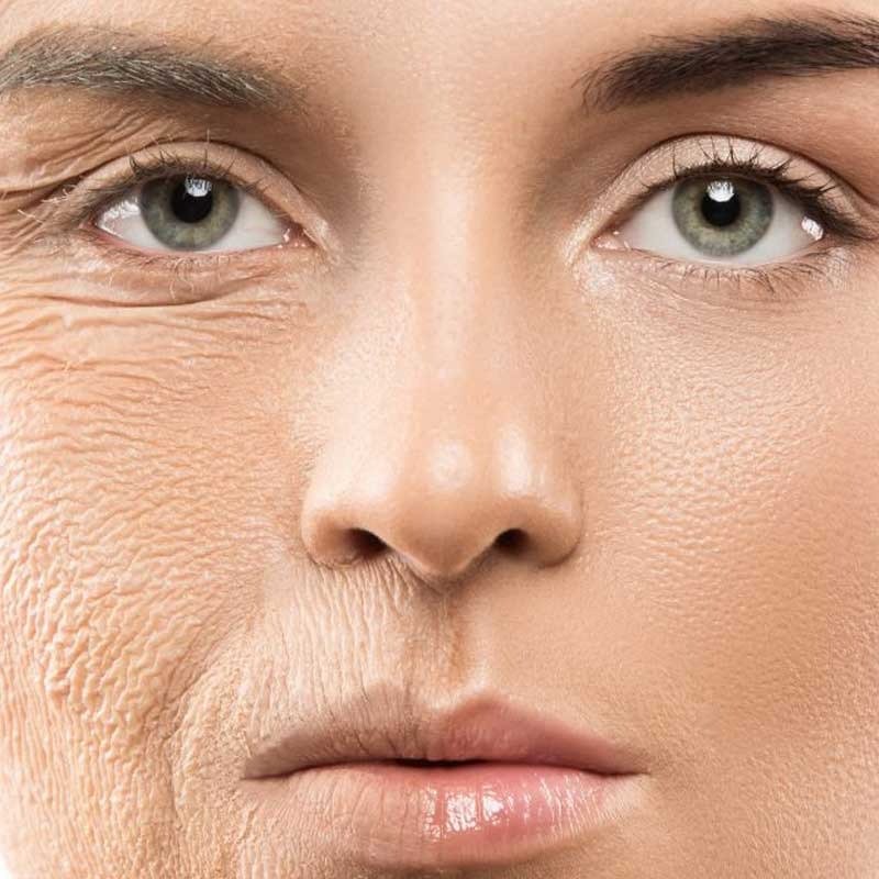 Résultat naturel avec lifting visage